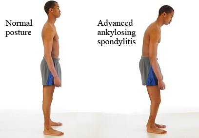 Ankylosing Spondylitis